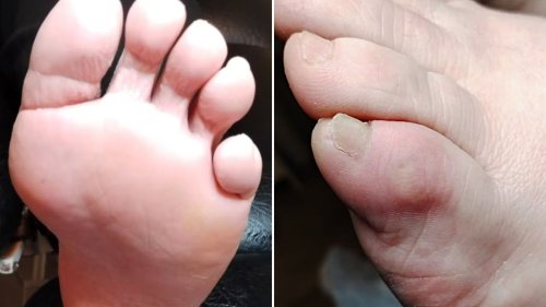 Why you need to check if you have an ‘Irish pinky toe’ and how it can mean your health is at risk