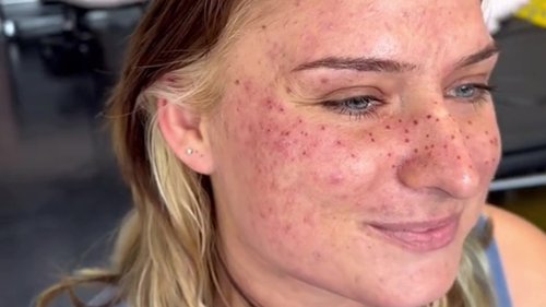 Tattooist proudly shows off client’s new ‘night sky’ face inkings… but trolls reckon she looks like she has measles