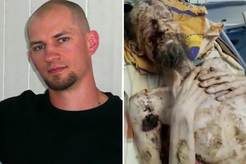 Face of emaciated ‘bear den’ man revealed as doctor says he’s actually suffering chronic psoriasis and was never mauled by beast