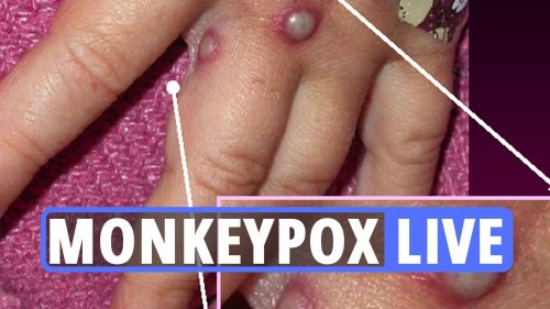 Monkeypox virus news LIVE – What is the virus & the symptoms you need to be aware of as UK cases rise to 78