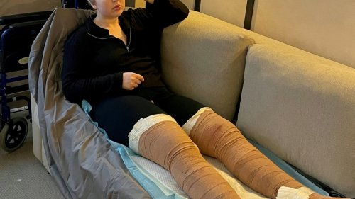I was fat-shamed by trolls for having tree trunk legs – so I paid £20k to get same surgery as Love Island star