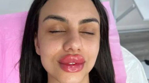 Lip filler technician proudly shows off the juicy pout she’s given to a client – & people are all saying the same thing