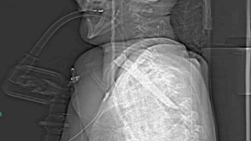Shocking X-ray shows 14cm blade lodged in man’s throat after he was stabbed in brawl – but he SURVIVED