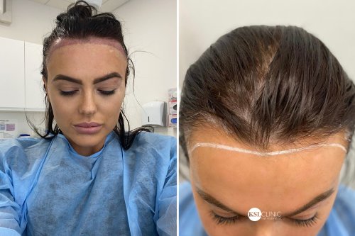 Love Island star Rosie Williams gets her confidence back after hair transplant by celebrity doctor