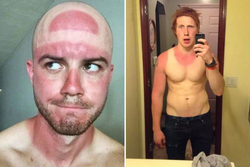 sunscreen for top of head