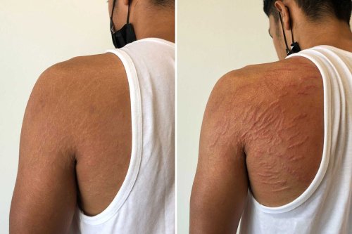 Tattoo artist helps people hide stretch marks and scars with unique no ink  method – and goes viral on TikTok | Flipboard
