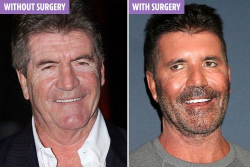 Simon Cowell’s ‘REAL’ face without Botox and plastic surgery revealed ...