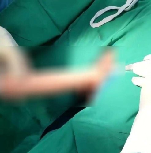 Bottoms up: Oversized sex toy lands man in hospital