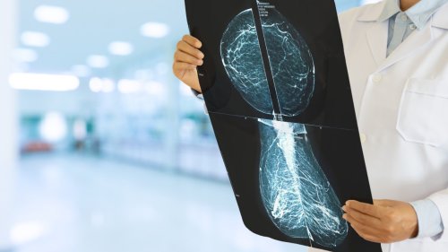 Mammogram-reading AI starts work in hospitals