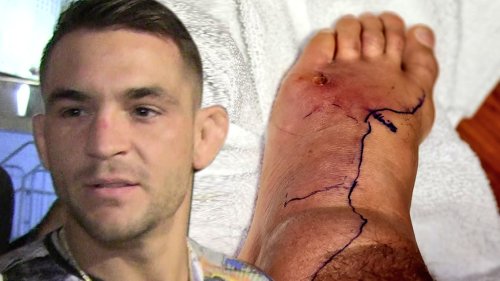UFC Star Dustin Poirier Check Out My Foot Infection ... 'Wut Da Helllll'