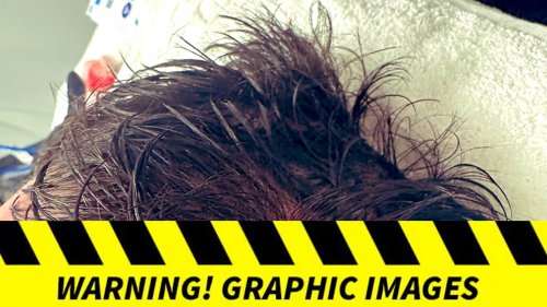 Finn Bálor's Head And Body Injuries -- Gruesome Pics | Flipboard