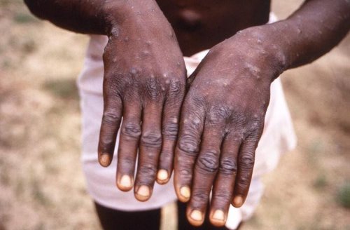 No plans for mandates in Pima County as monkeypox cases increase