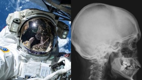 Astronauts are not recovering from bone loss long after coming home