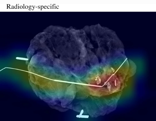 Researchers Develop AI Model to Improve Tumor Removal Accuracy During Breast Cancer Surgery | Newsroom