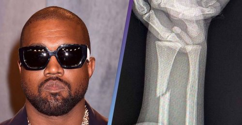 Kanye West Flooded With Support Following Rare Broken Bones Instagram Post