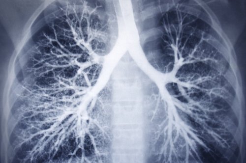 Early Warning Signs Of Lung Cancer As Place In The Sun s Jonnie Irwin 