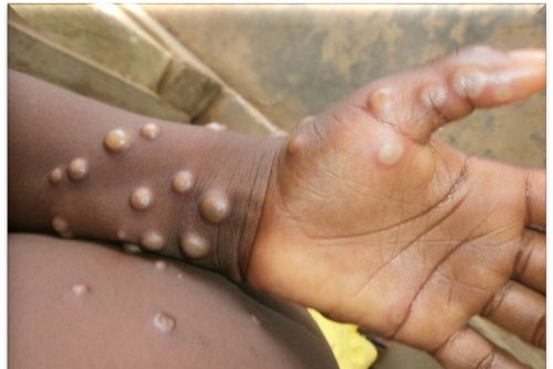 Mpox infections double last year's rate