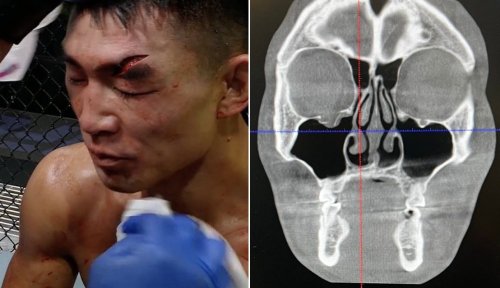 UFC's Song Yadong posts X-ray of fractured orbital from Cory Sandhagen fight: 'I was seeing triple'