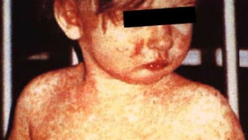 Measles outbreak in Florida grows: What to know about virus flare-ups across the US