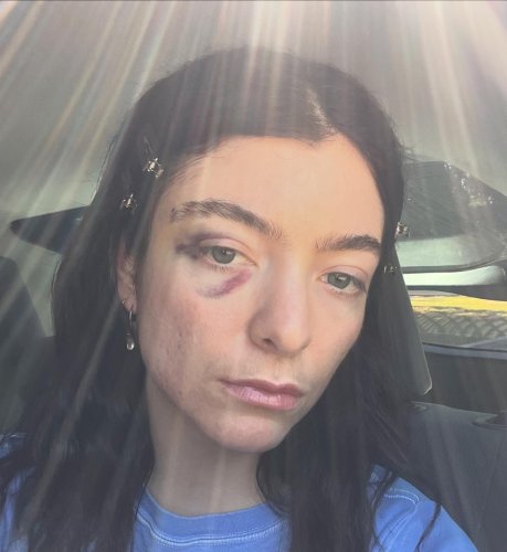 Lorde Deletes Everything From Her Instagram Except New Black Eye Photos | Flipboard