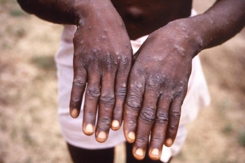 African Officials: Monkeypox Spread Is Already an Emergency