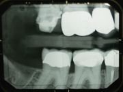 How Long Do Teeth Survive After Root Canal?