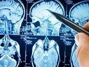 FDA Approves New ALS Drug Despite Uncertain Data