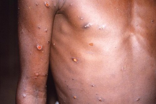 Presumptive Case of Monkeypox Probed in South Florida