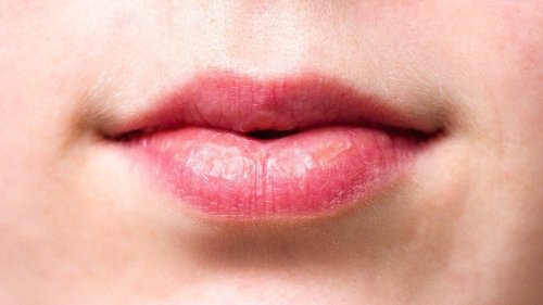 Dicke Lippe: Diese Hausmittel helfen gegen geschwollene Lippen