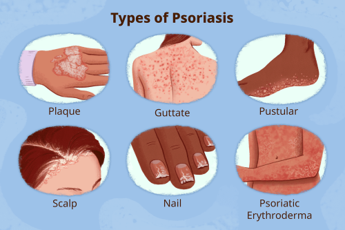 common-signs-and-symptoms-of-psoriasis-flipboard