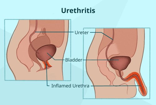 How Urethritis Feels and Look