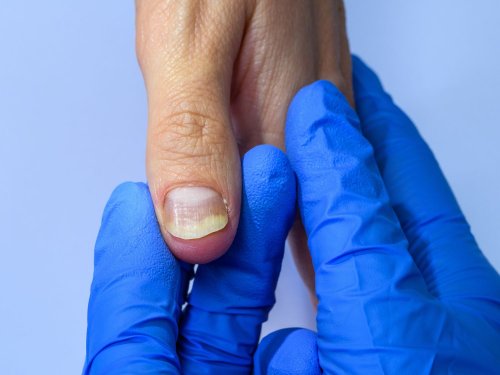 Yellow Nail Syndrome: What to Know