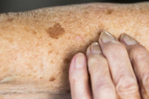 What Are Liver Spots?