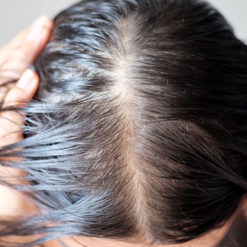 Tingling Sensation In Head Scalp Changes, Causes, Treatment Flipboard