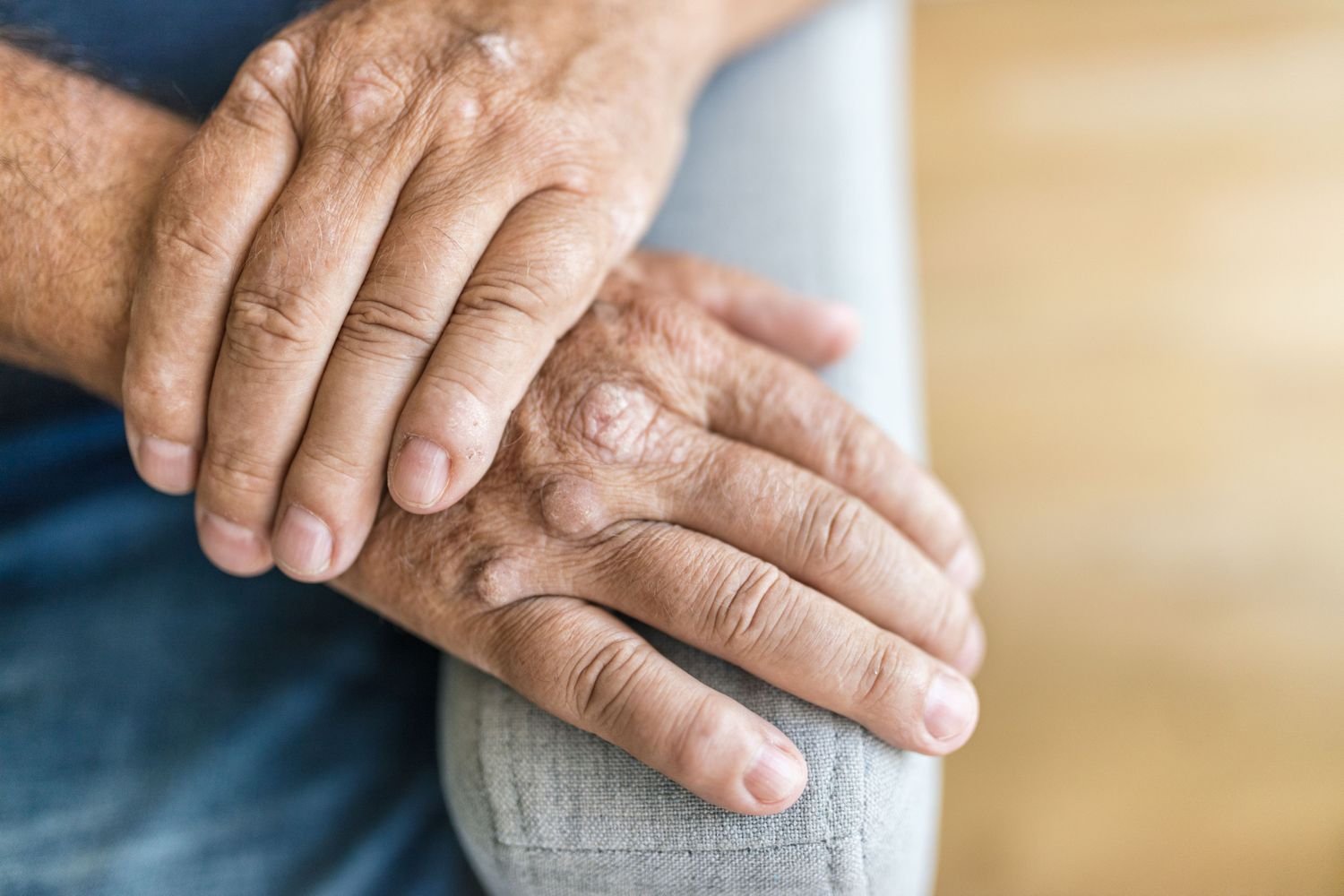 What Causes Psoriatic Arthritis?