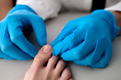 ingrown-toe-nails-andover-podiatry-clinic