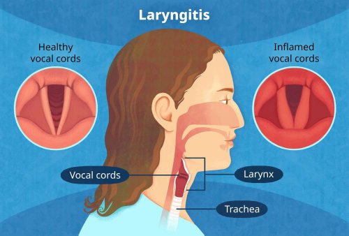 is-laryngitis-contagious-flipboard