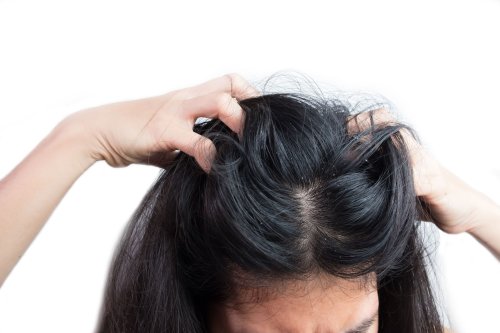 What Is A Scalp Yeast Infection Flipboard