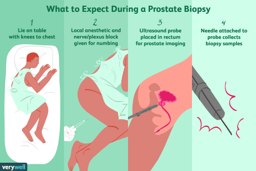 Feeling Prepared Before a Prostate Biopsy