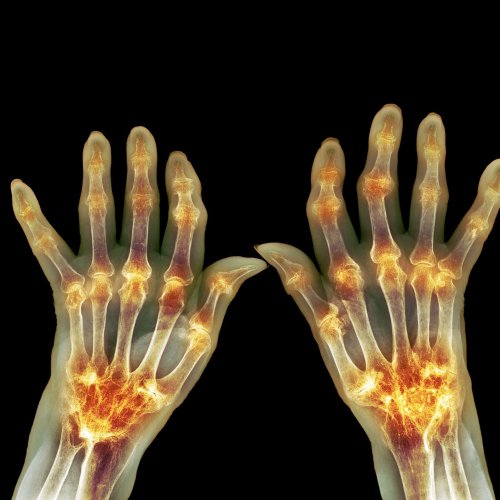 What Is Bone Erosion from Rheumatoid Arthritis?