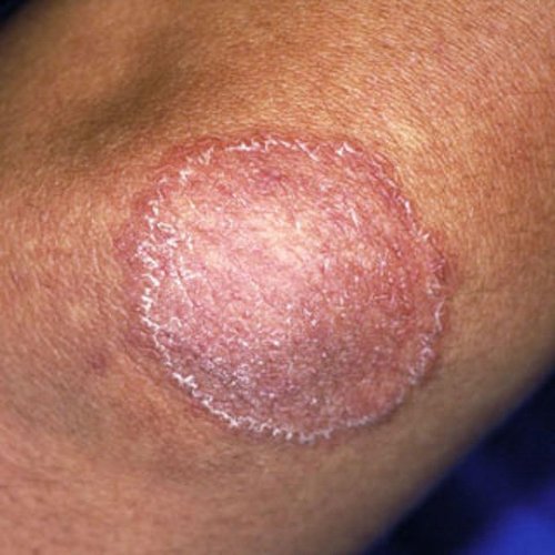 What Is Tinea Corporis What Is Tinea Corporis