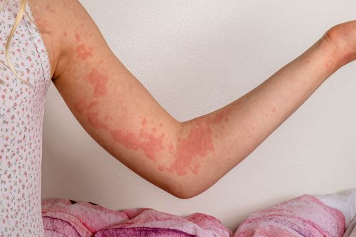 What Are Autoimmune Hives and What Causes Them?