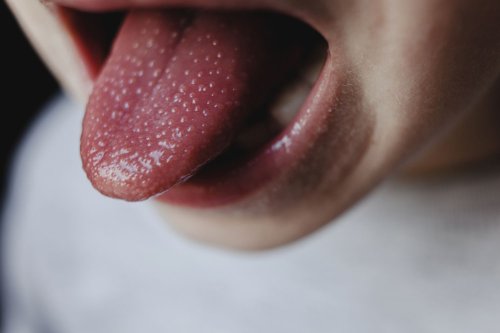 What Causes Strawberry Tongue?
