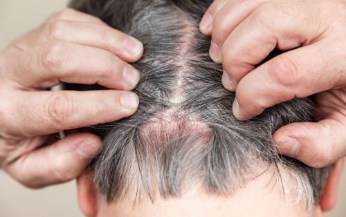 causes-of-scalp-scabs-and-how-to-treat-them-flipboard