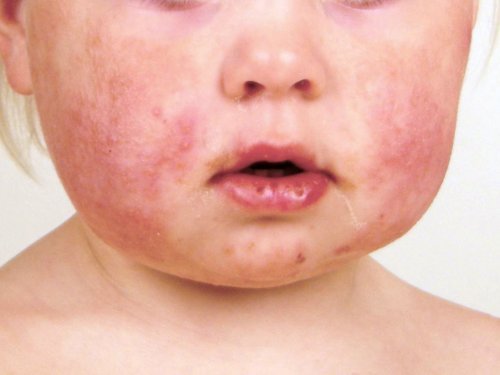 Gianotti-Crosti Syndrome: A Common Childhood Rash