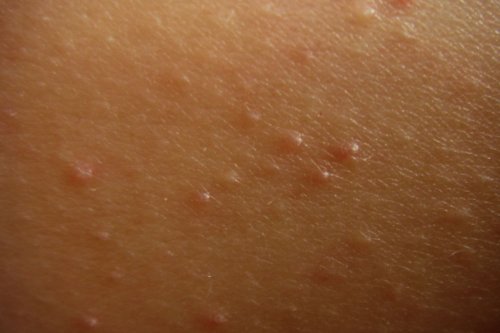 what-causes-bumps-on-arms-keratosis-pilaris-flipboard