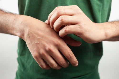 How to Stop Eczema Itching: Controlling the Urge