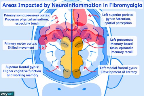 Autoimmunity and Neuroinflammation in Fibromyalgia