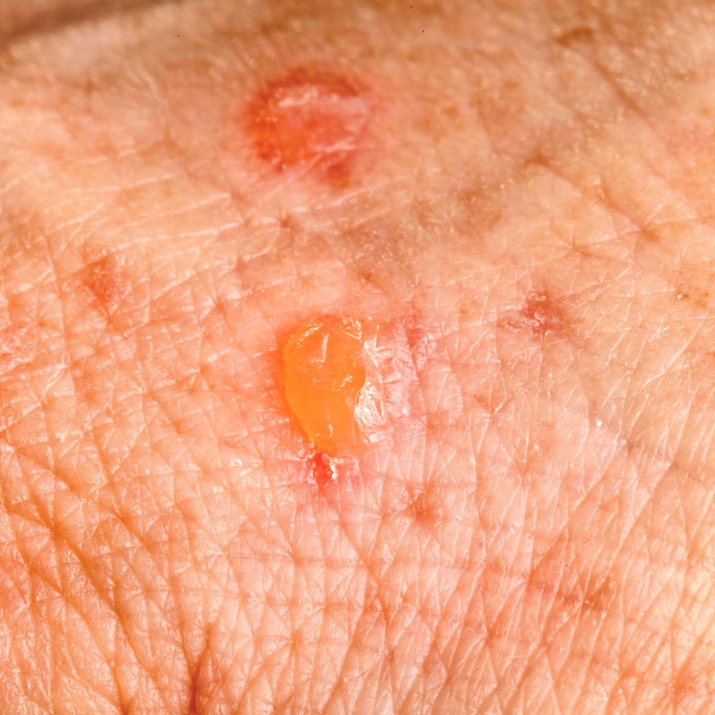 skin-cancer-todd7251-flipboard