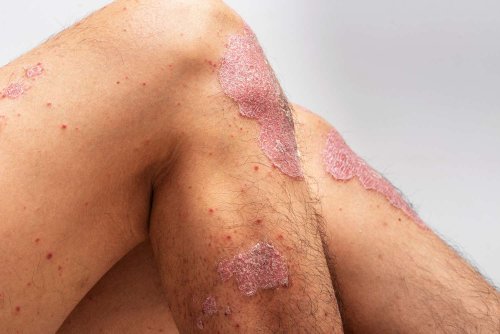 Why Does Psoriasis Show Up on Knees?